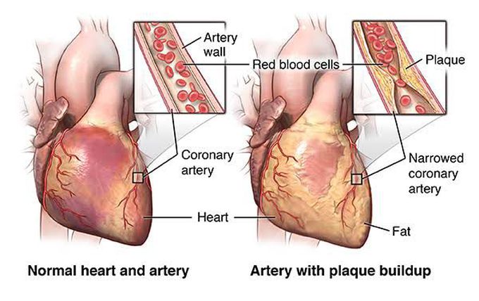 Angina Pectoris