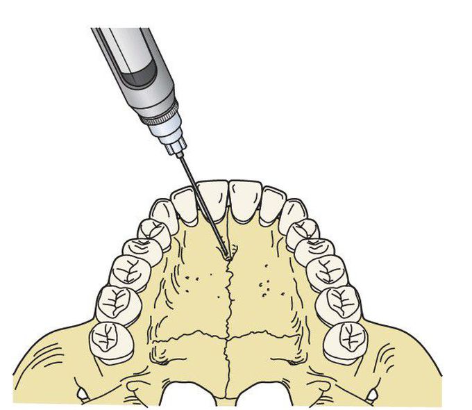 Incisive nerve