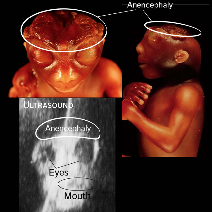 Anencephaly