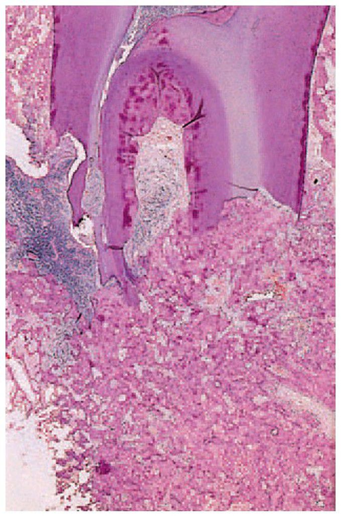 Cementoblastoma