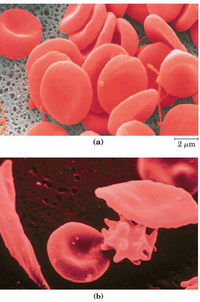 Sickle cell anemia
