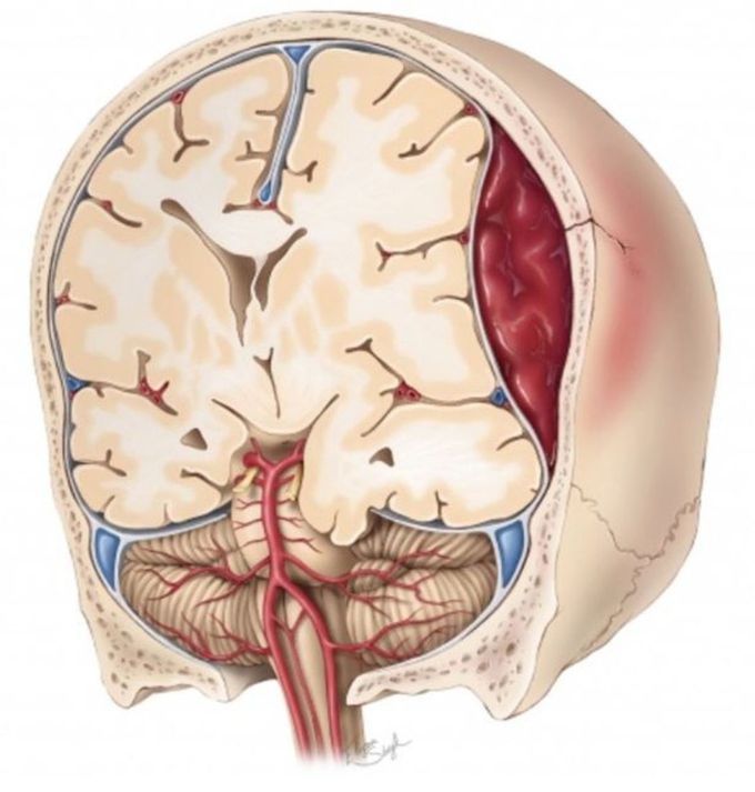 A large  epidural hematoma(edh)