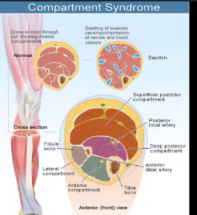Compartment syndrome