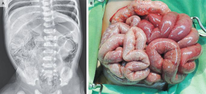 Pneumatosis Intestinalis in Necrotizing Enterocolitis