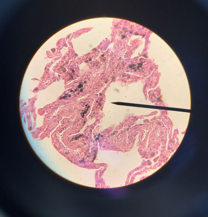 Name the pathology