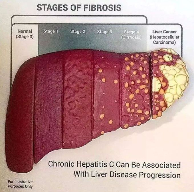 Stages of Liver Fibrosis