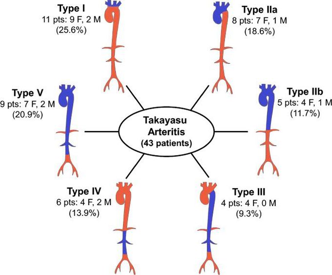 What Is Takayasu's Arteritis?

Takayasu's arteritis is an uncommon condition in which inflammation damages large and medium-sized arteries. The arteries most commonly affected are the branches of the aorta (the main blood vessel that leaves the heart), including the blood vessels that supply blood to the arms and travel through the neck to provide blood to the brain. The aorta itself is also often affected.

Less commonly, arteries that provide blood to the heart, intestines, kidneys, and legs may be involved..