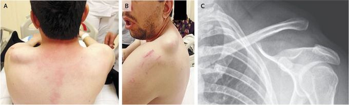 Acromioclavicular Joint Separation