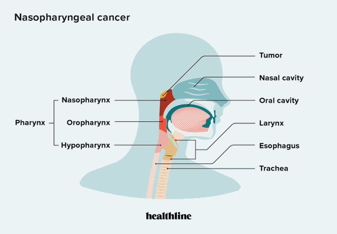 Risk factors for nasopharyngeal carcinoma - MEDizzy