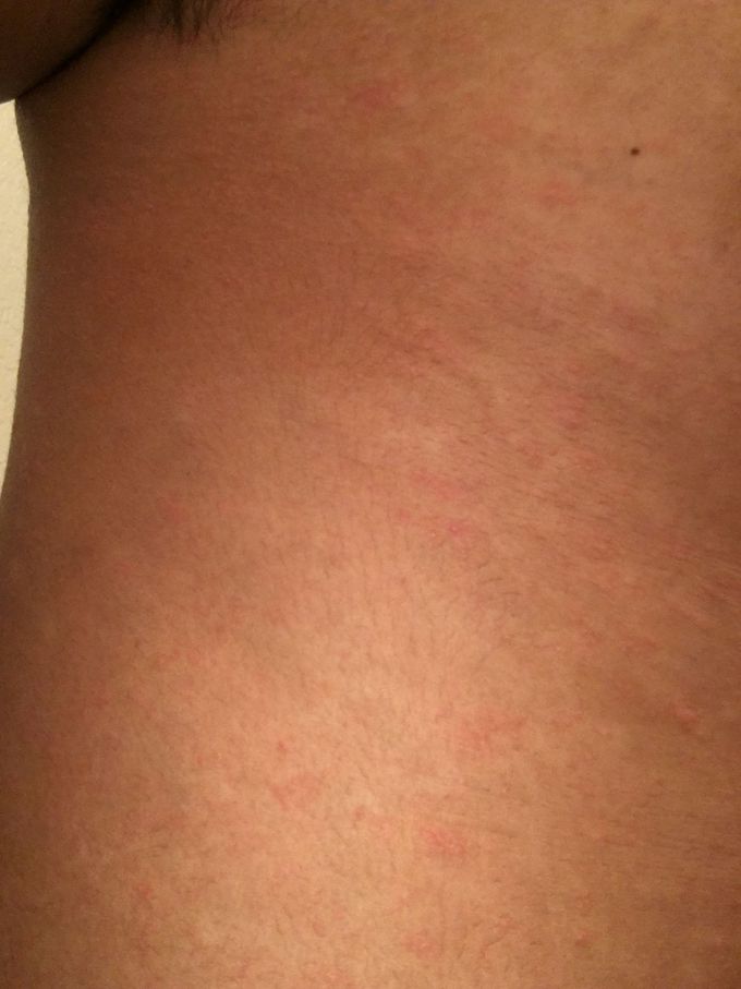 Rash?