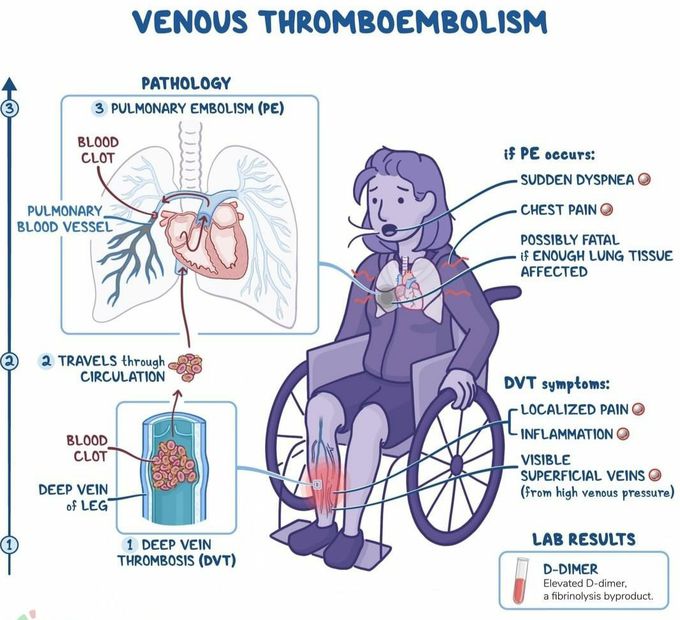 Venous thromboembolism