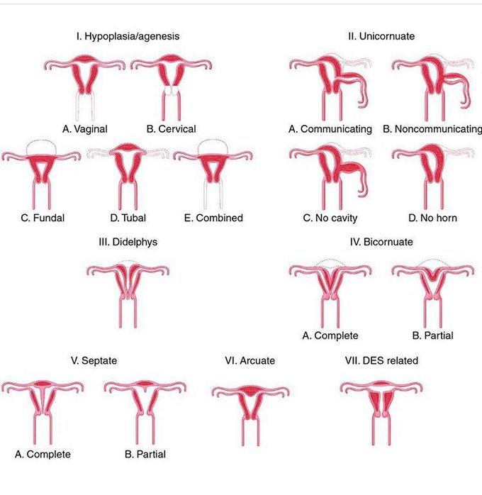 Müllerian Duct Malformations
