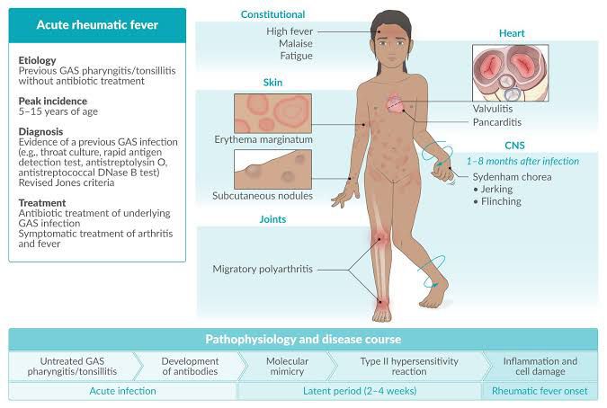 Causes Of Rheumatic Fever MEDizzy