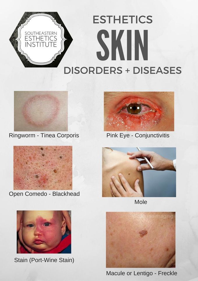 Skin disease