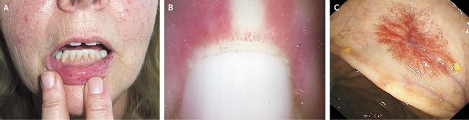 Osler–Weber–Rendu Syndrome