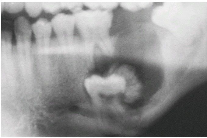 Calcifying Epithelial Odontogenic Tumor