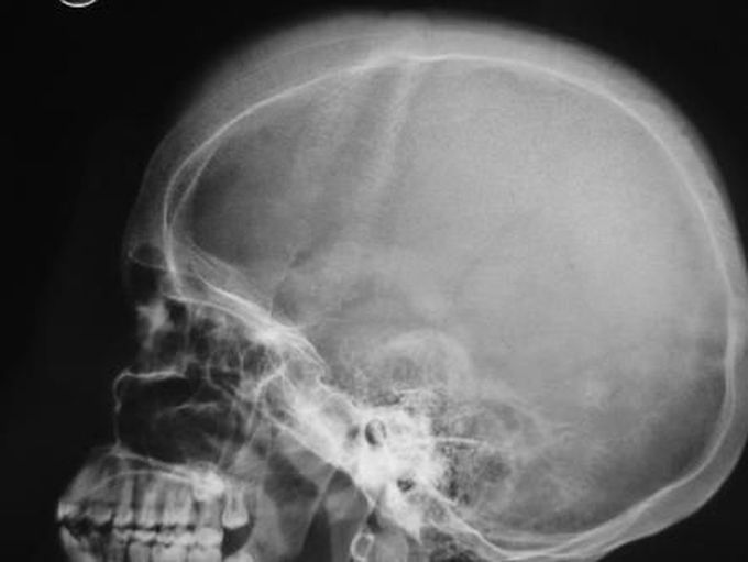 'Hair on End' Sign on Skull Radiograph