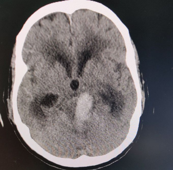 Hemorrhagic CVA