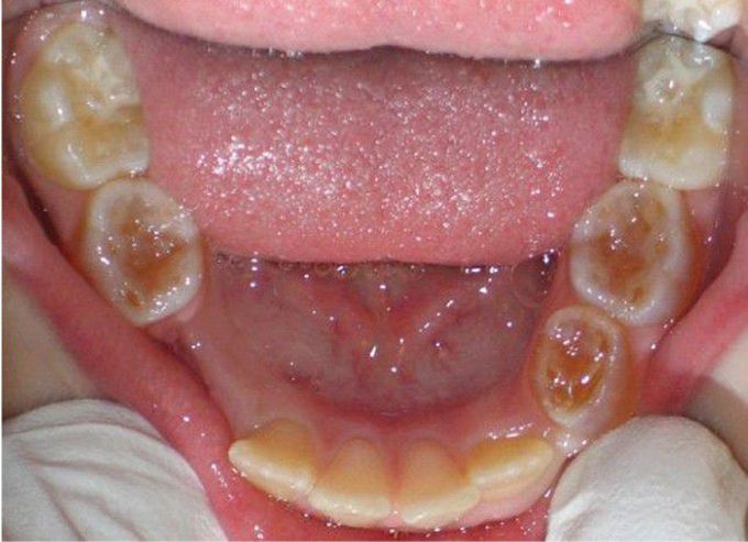 Dentin Dysplasia Type II (DD-II)