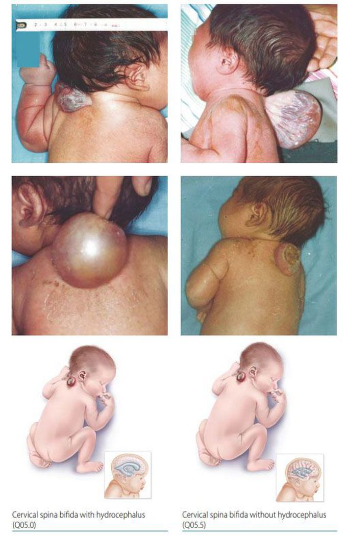 Spina Bifida - A Neural Tube Defect