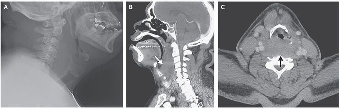 Spontaneous Retropharyngeal Hematoma