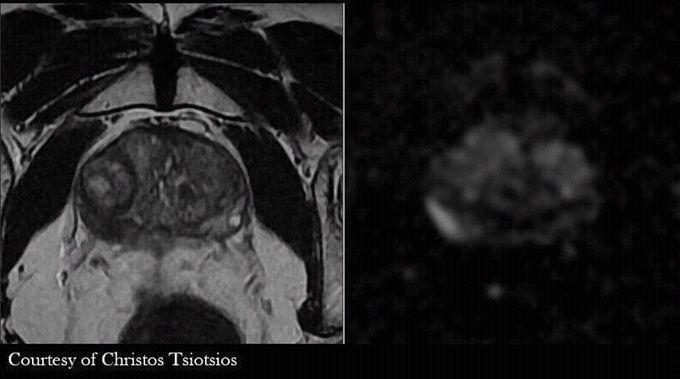 MR Imaging of the prostate gland