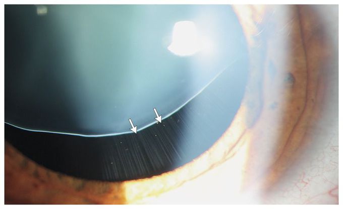 Ectopia Lentis in Marfan's Syndrome