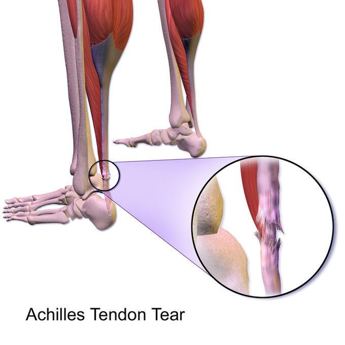 Achilles tendon