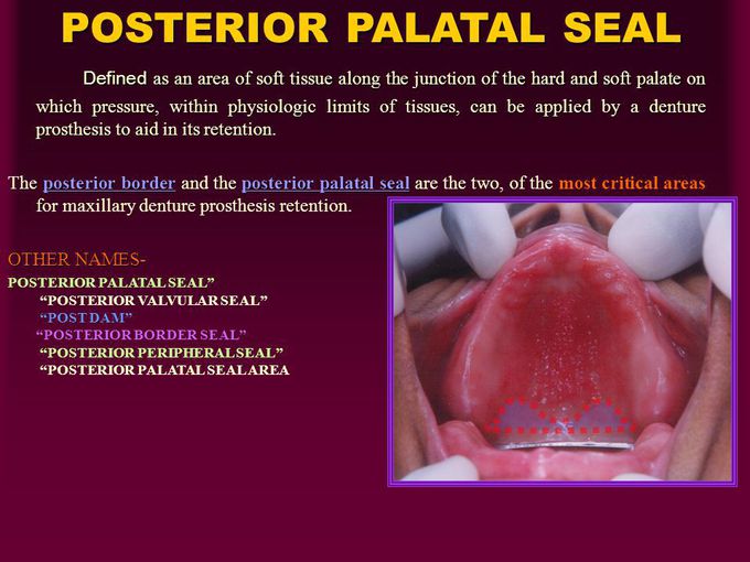 posterior palatal seal