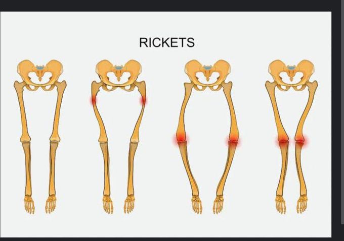 A deficiency of vit D leads to condition osteomalacia( rickets in children)