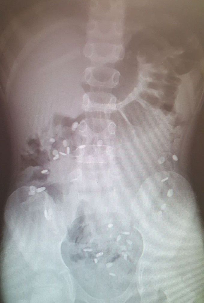 A 2 yr old child was brought to ER for abdominal pain.👆