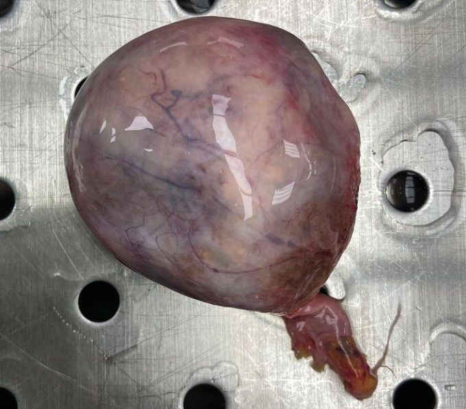 Ovarian teratoma