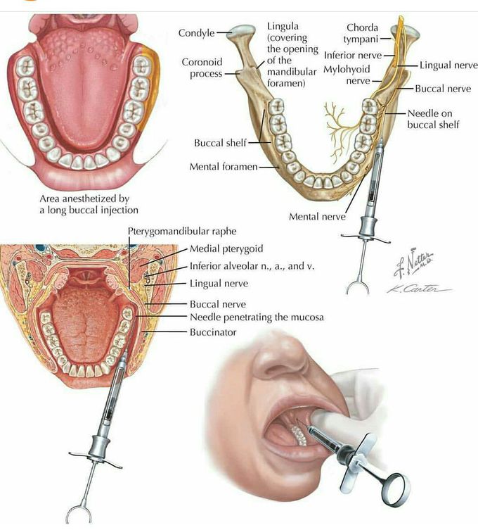 👍Correct long buccal nerve block technique👍