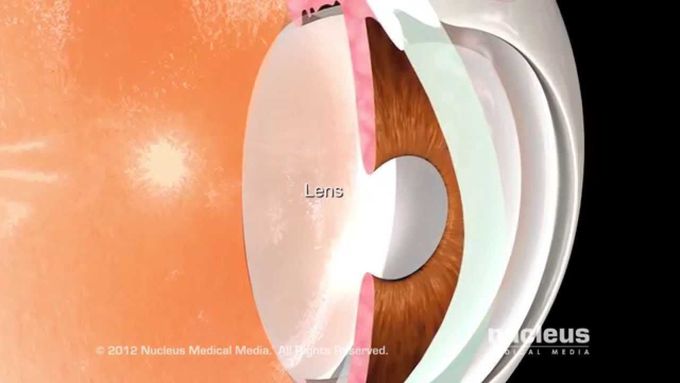 Cataract Surgery: Lens Extraction and Prosthetic Lens Insertion