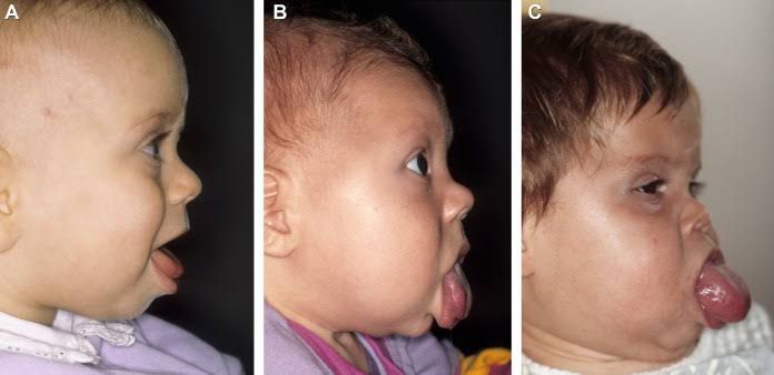 beckwith wiedemann syndrome adult