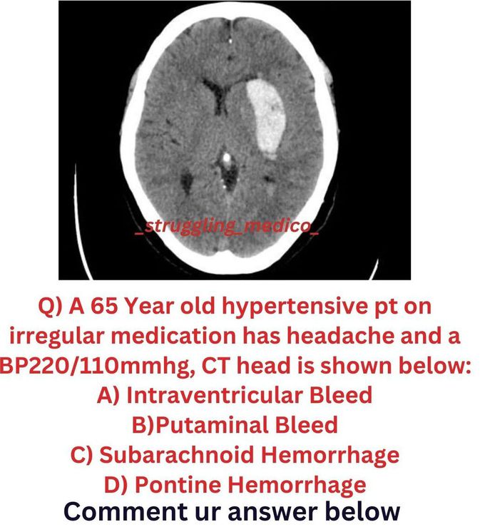 Identify the Brain Bleed