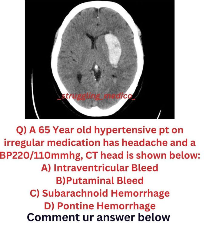 Identify The Brain Bleed - Medizzy