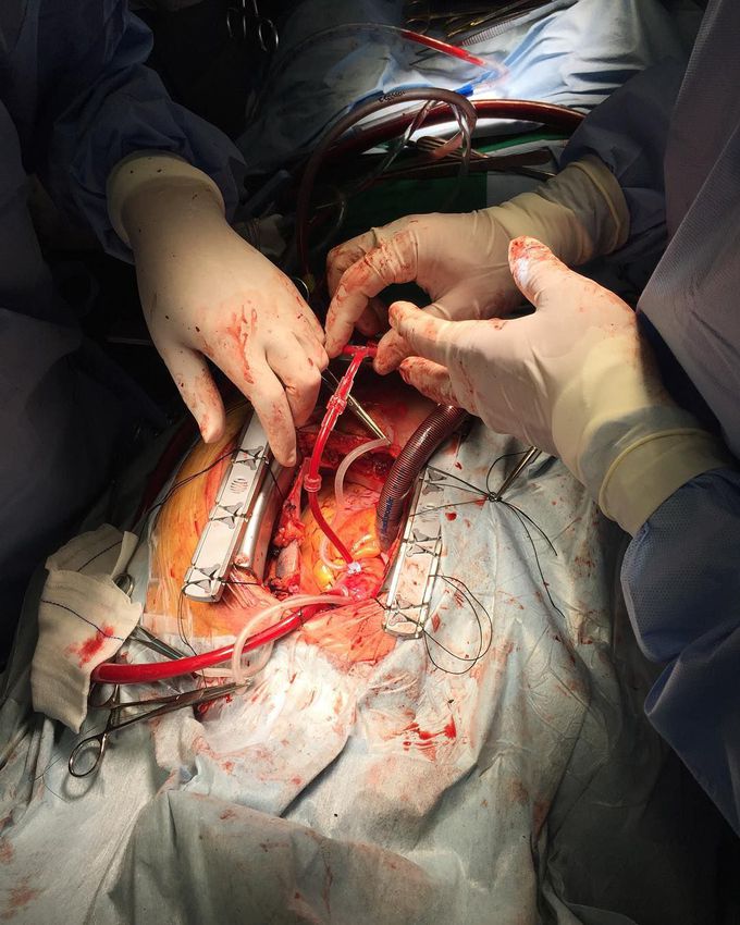 On-pump CABG is the oldest and time-honored method.
