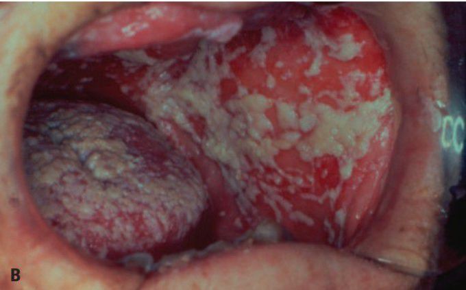 Severe oral thrush