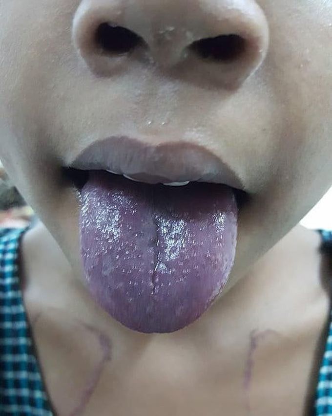 Blue tounge?? diagnosis