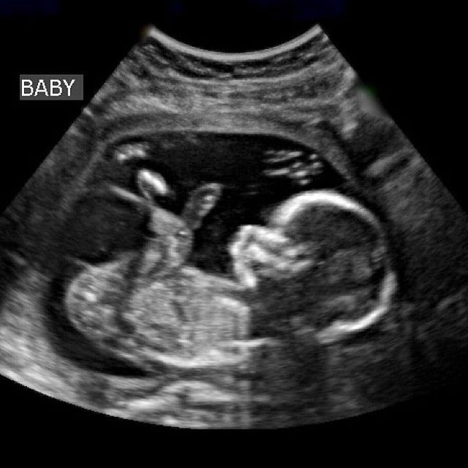 Baby seen in a pregnancy ultrasound test - MEDizzy