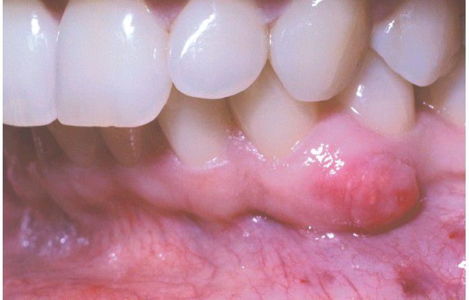 Peripheral Calcifying Odontogenic Cyst.