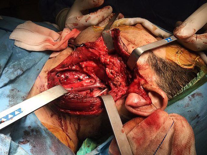 Parotidectomy and neck dissection to explore and resect a benign parotid gland tumor! 