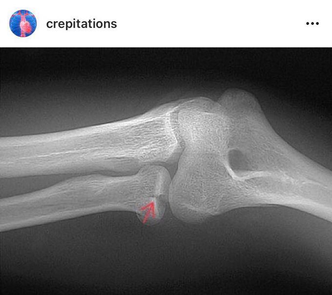 Radial Head Fracture (xRay)