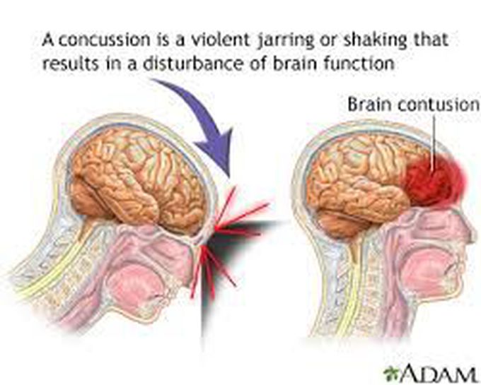 Causes of concussion