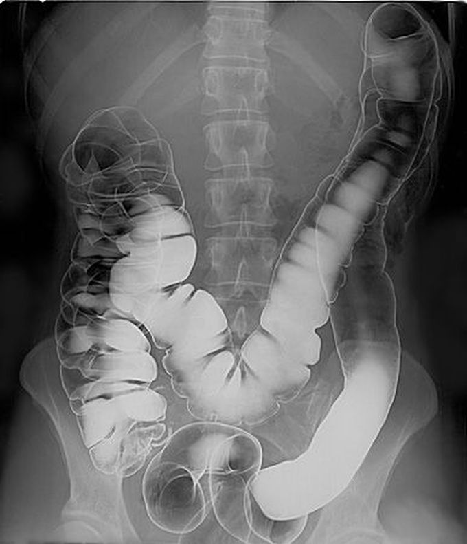 Double Contrast Barium Enema Technique