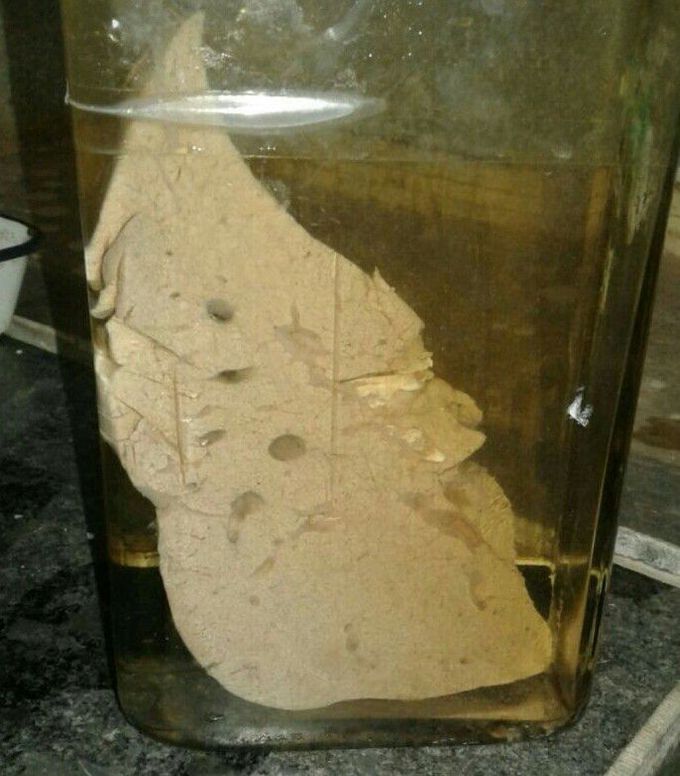 Fatty Liver