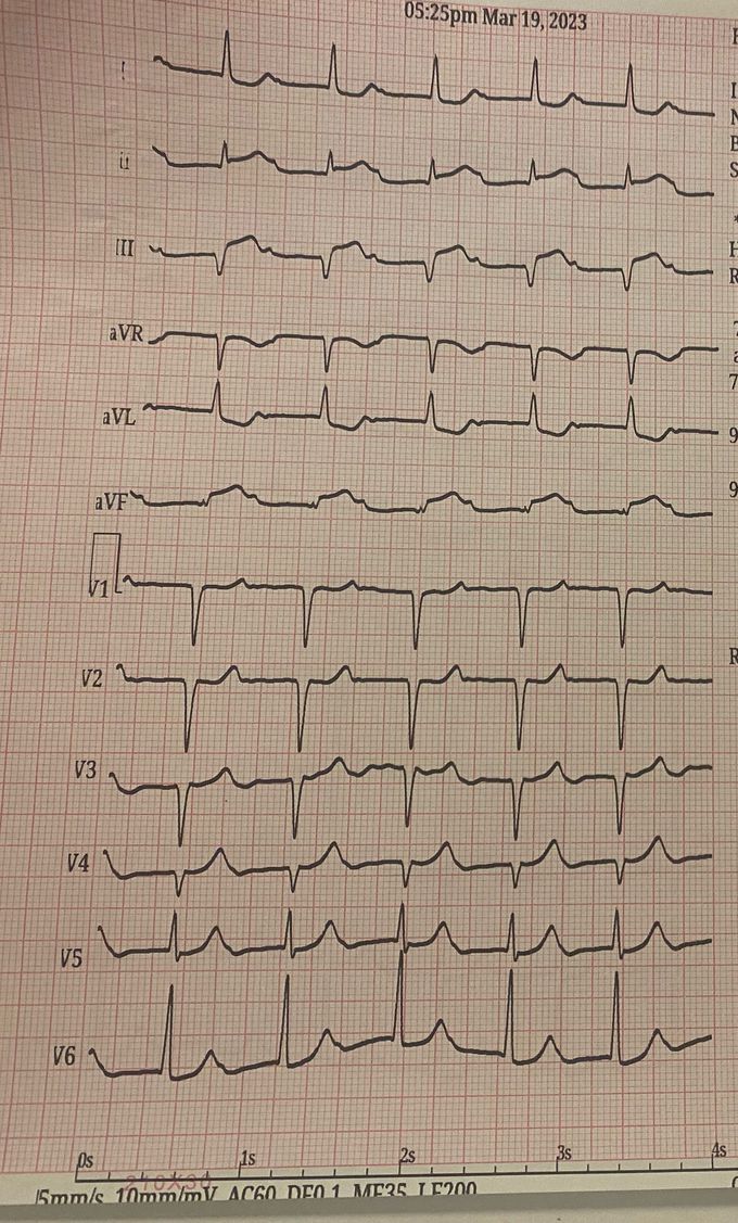 71  YO female smoker presented with chest pain , PMH is DM and HT