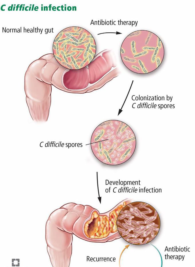 Clostridium difficile