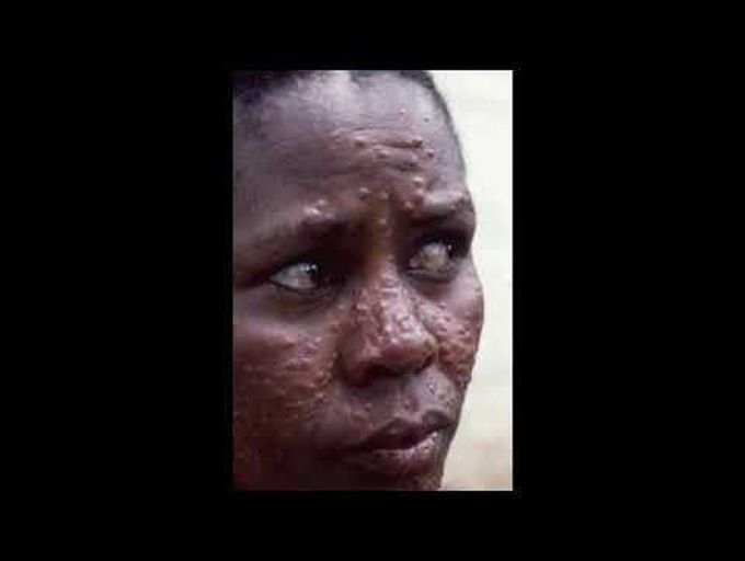 What is the PKDL, it's clinical Feature and Lab diagnosis ?